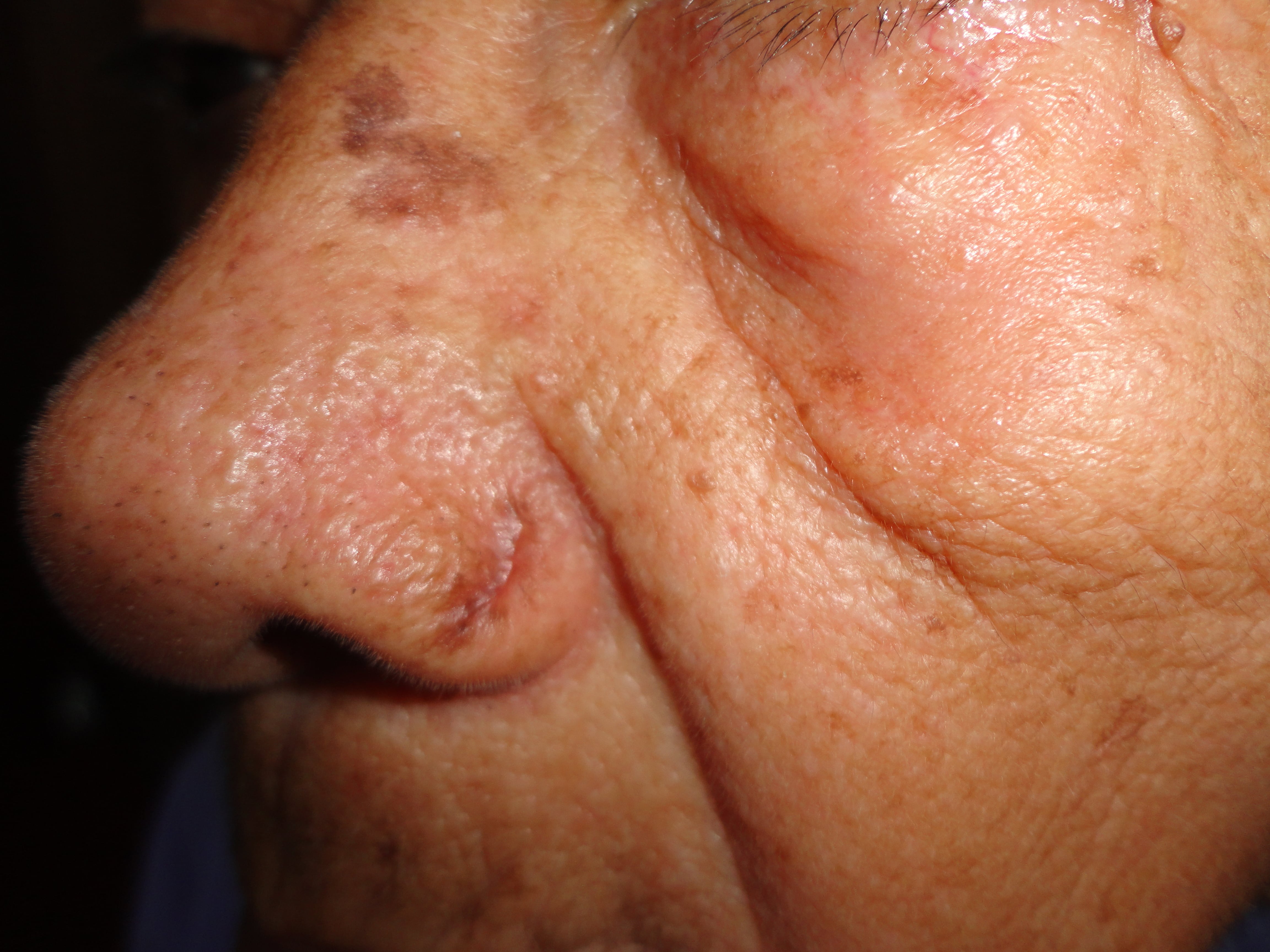 CARCINOMA BASOCELULAR DE NARIZ + CURETAJE + IMIQUIMOD-  CICATRIZ