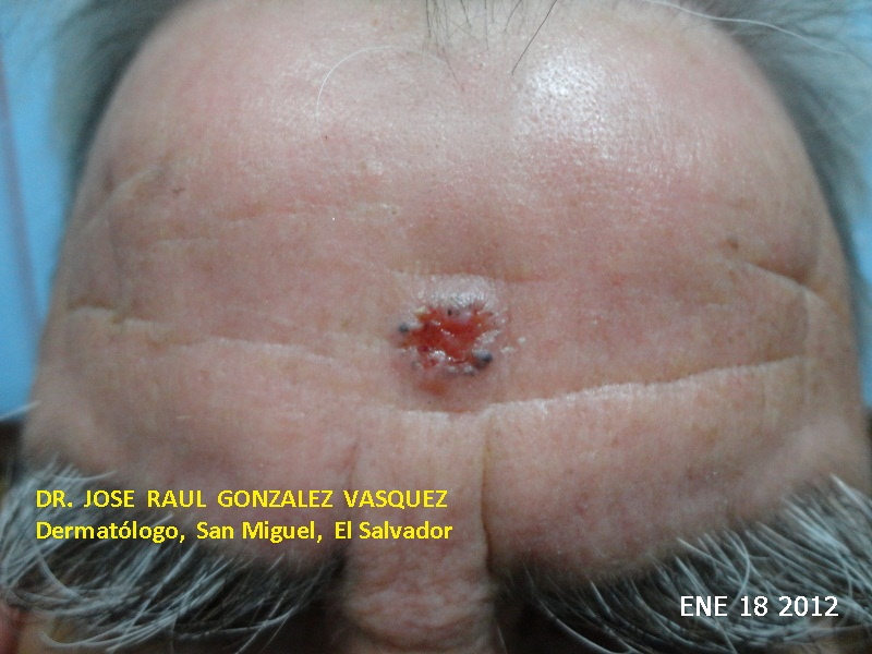 CARCINOMA BASOCELULAR DE LA FRENTE - CURETAJE + IMIQUIMOD
