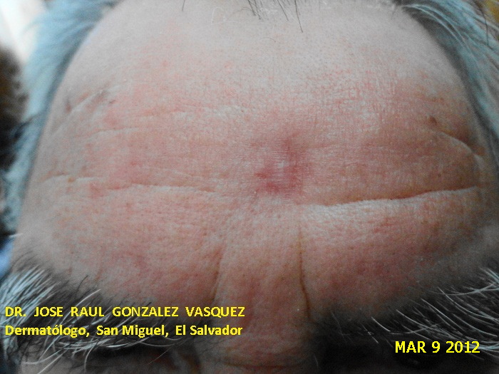 CARCINOMA BASOCELULAR DE LA FRENTE - CURETAJE + IMIQUIMOD - CICATRIZ
