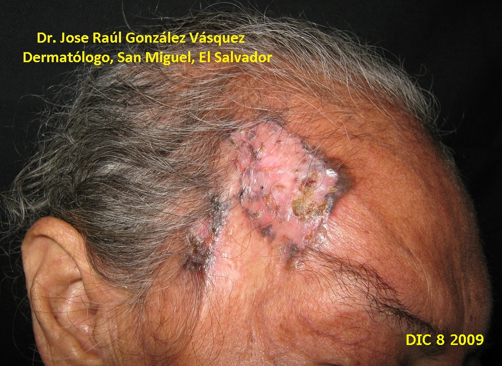 CARCINOMA BASOCELULAR FRONTO TEMPORAL DERECHO