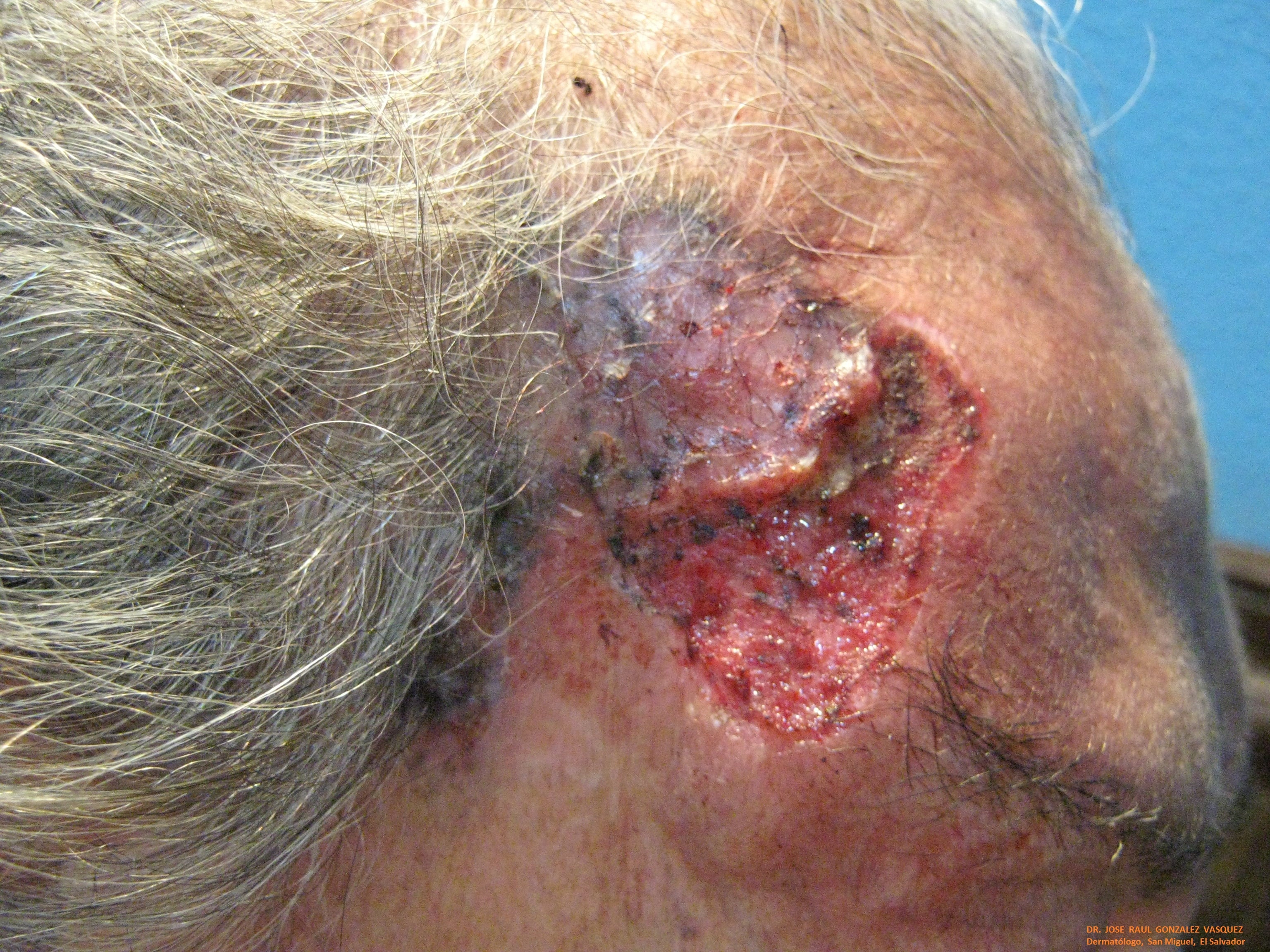 CARCINOMA BASOCELULAR - CURETAJE