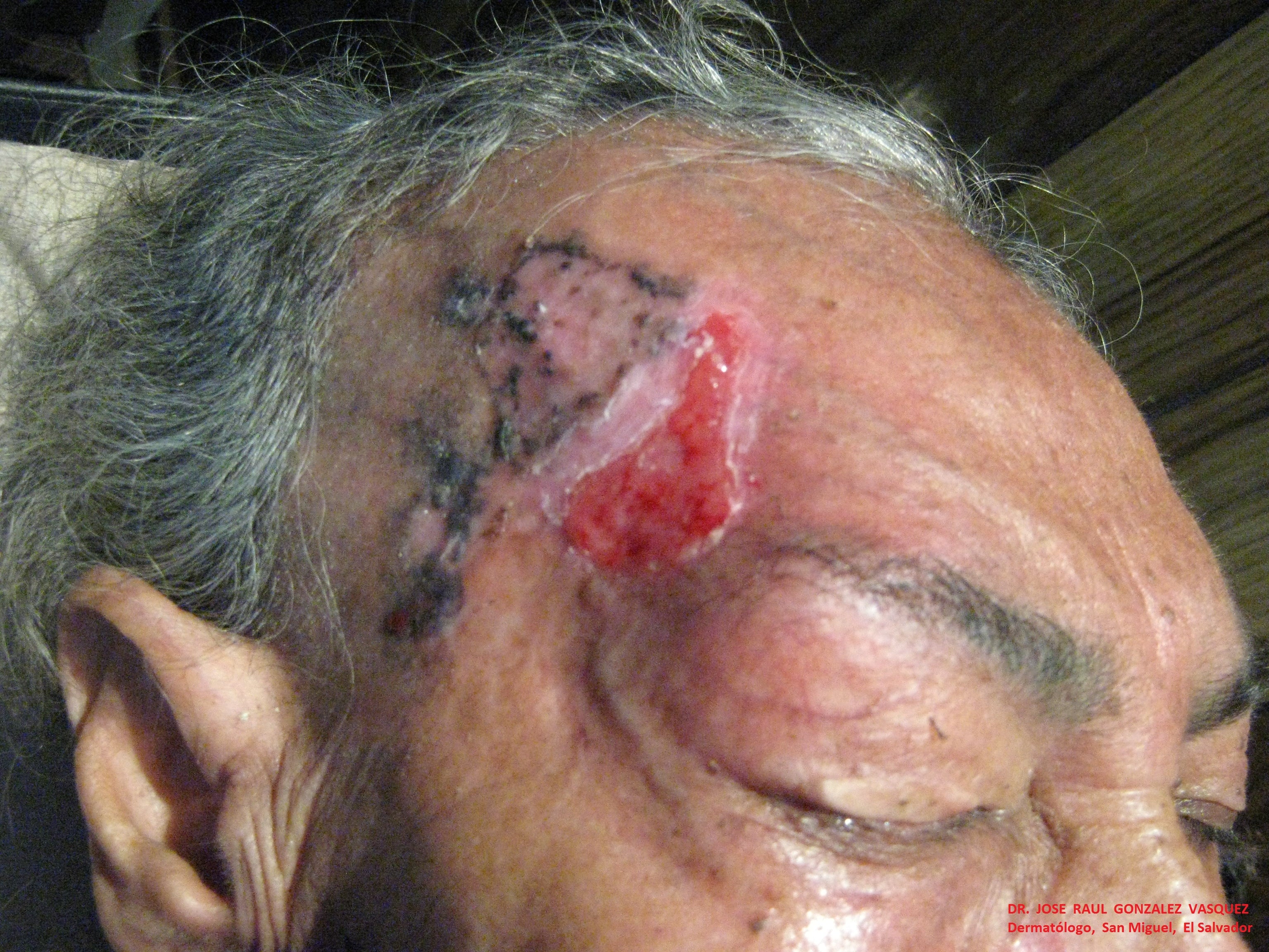 CARCINOMA BASOCELULAR - CURETAJE