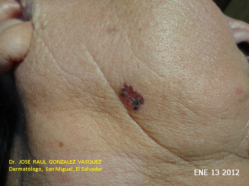 CARCINOMA BASOCELULAR DE MANDIBULA DERECHA