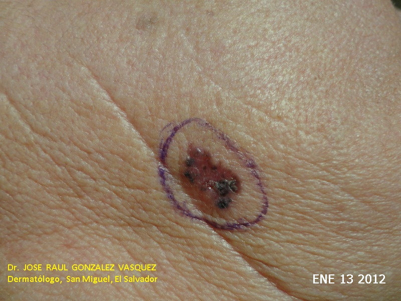 CARCINOMA BASOCELULAR - MARCAJE
