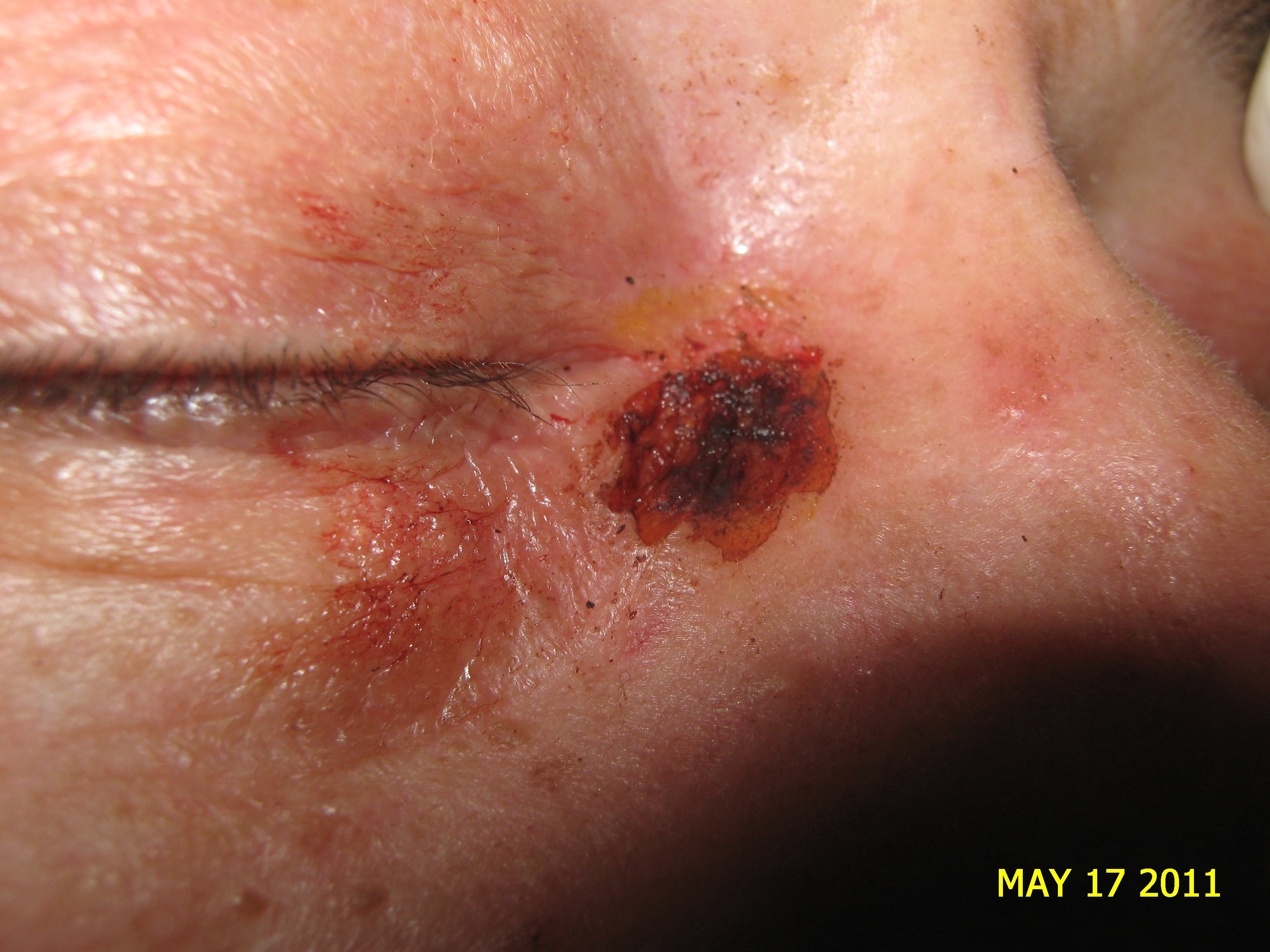 CARCINOMA BASOCELULAR - CURETAJE