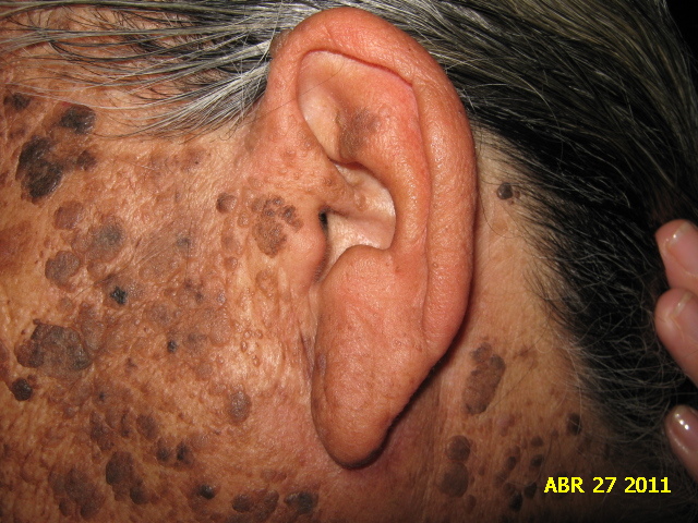 CARCINOMA BASOCELULAR -CURETAJE + IMIQUIMOD