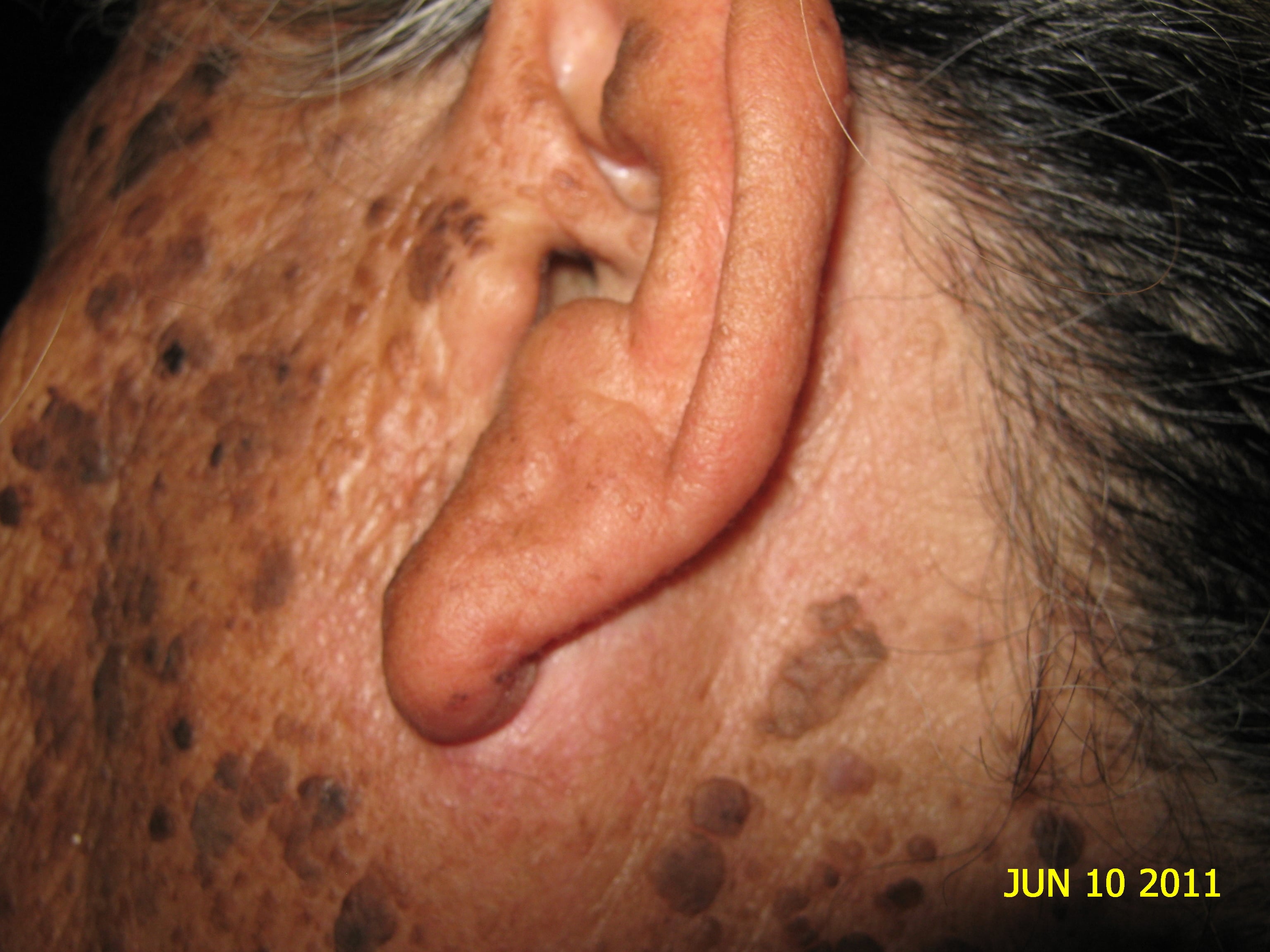 CARCINOMA BASOCELULAR - CURETAJE + IMIQUIMOD