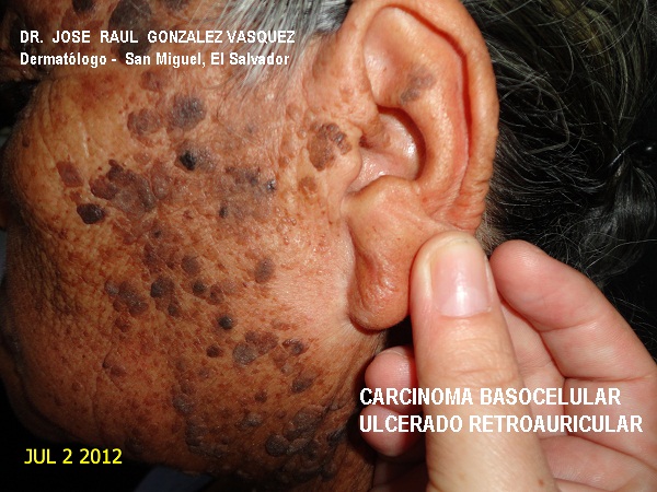 CARCINOMA BASOCELULAR - CURETAJE + IMIQUIMOD
