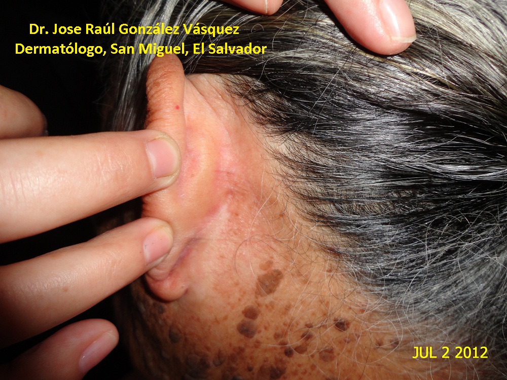 CARCINOMA BASOCELULAR - CURETAJE + IMIQUIMOD