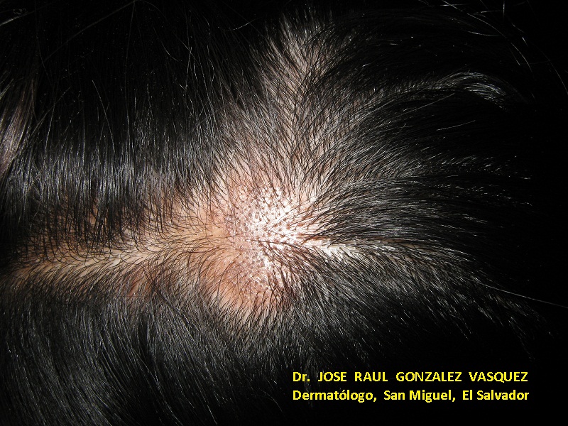ALOPECIA CICATRIZAL -LUPUS ERITEMATOSO DISCOIDE