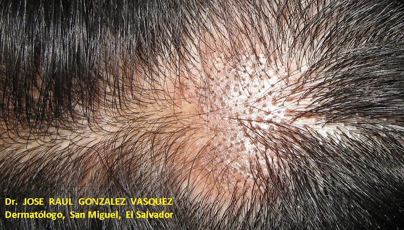 ALOPECIA CICATRIZAL -LUPUS ERITEMATOSO DISCOIDE
