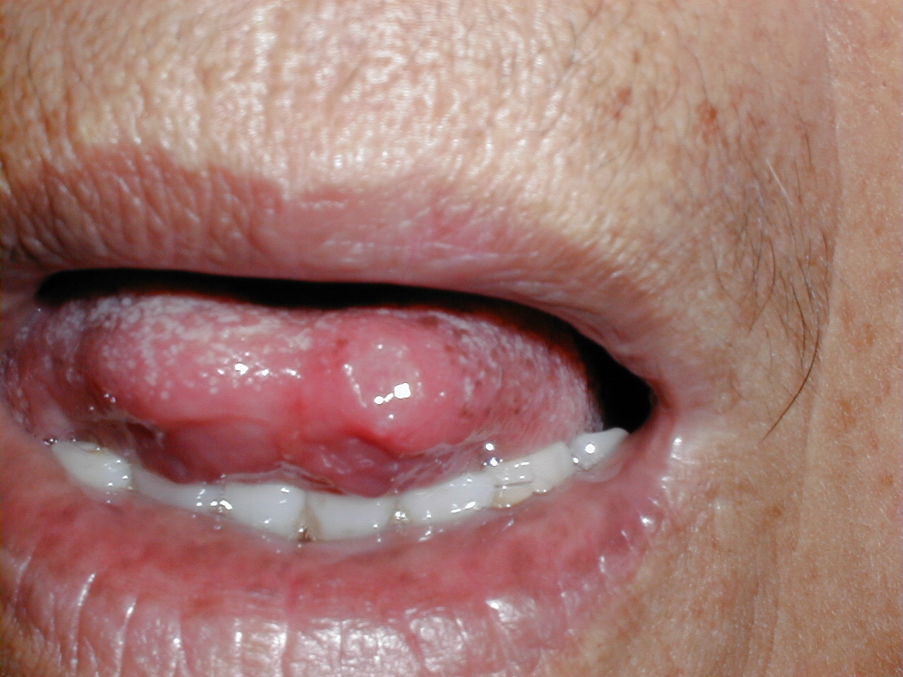 AFTAS EN MUCOSA ORAL