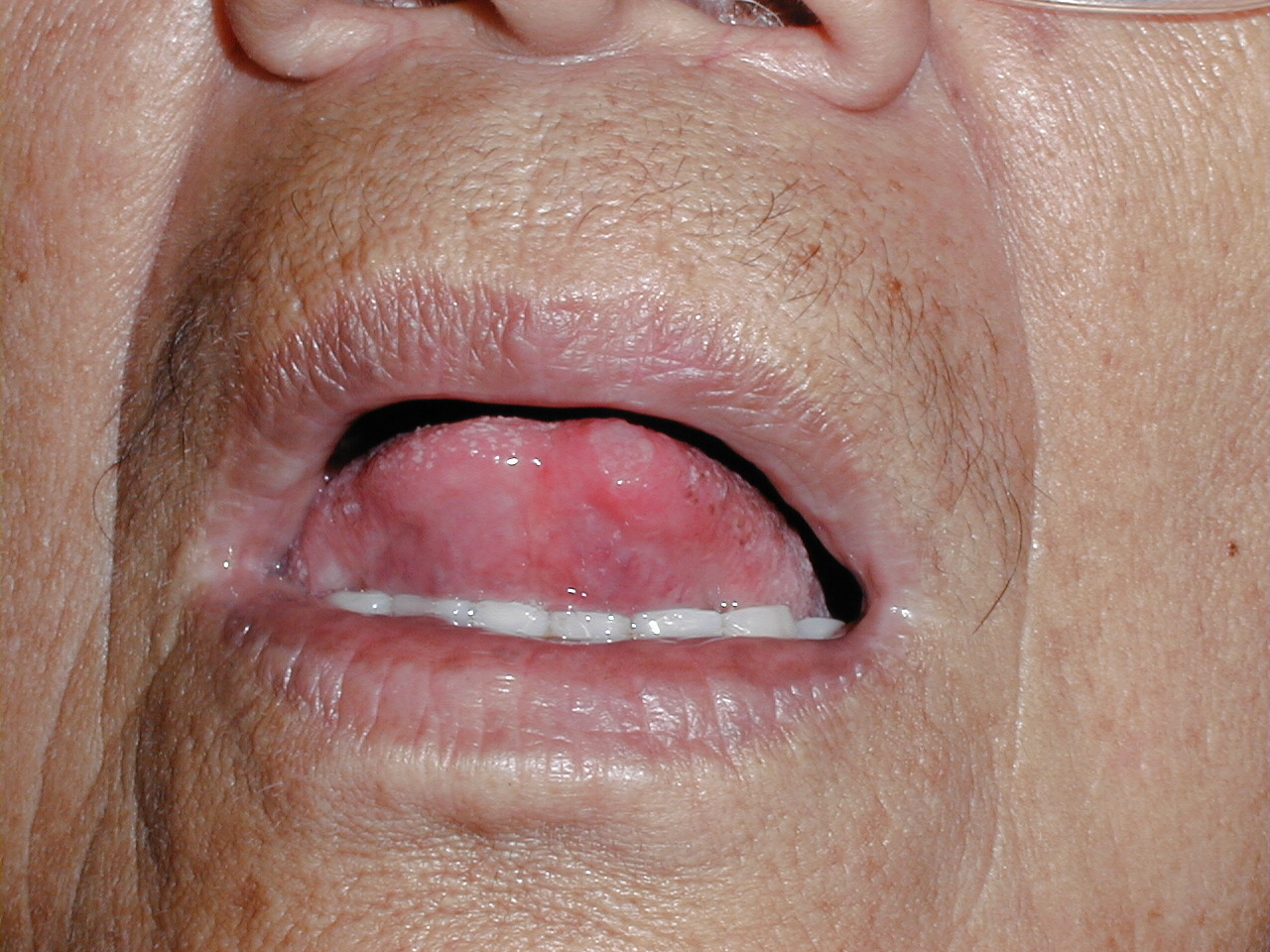 AFTAS EN MUCOSA ORAL