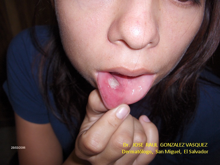 AFTAS EN MUCOSA ORAL