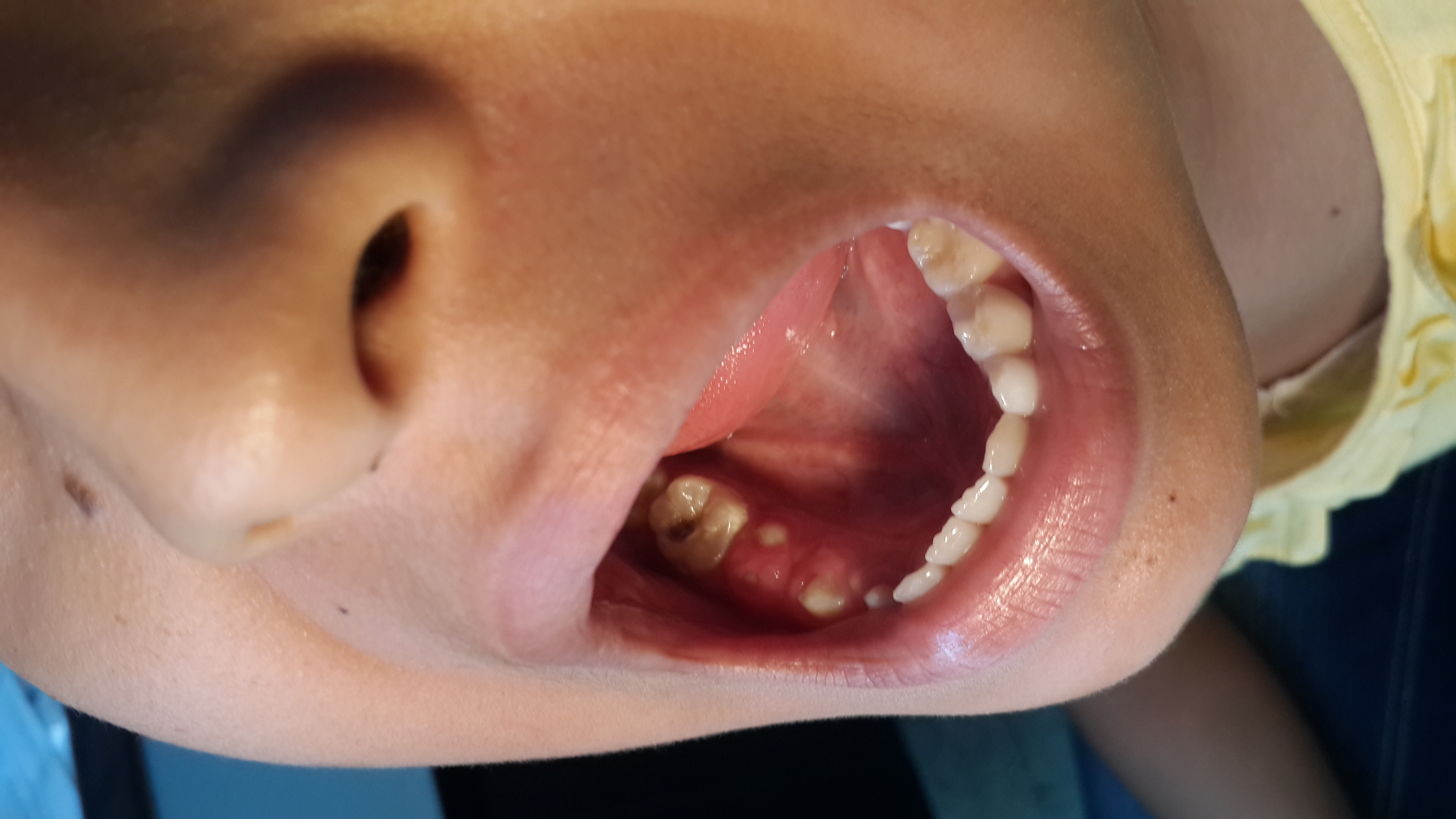 FISTULA CUTANEA PERIODONTOGENICA