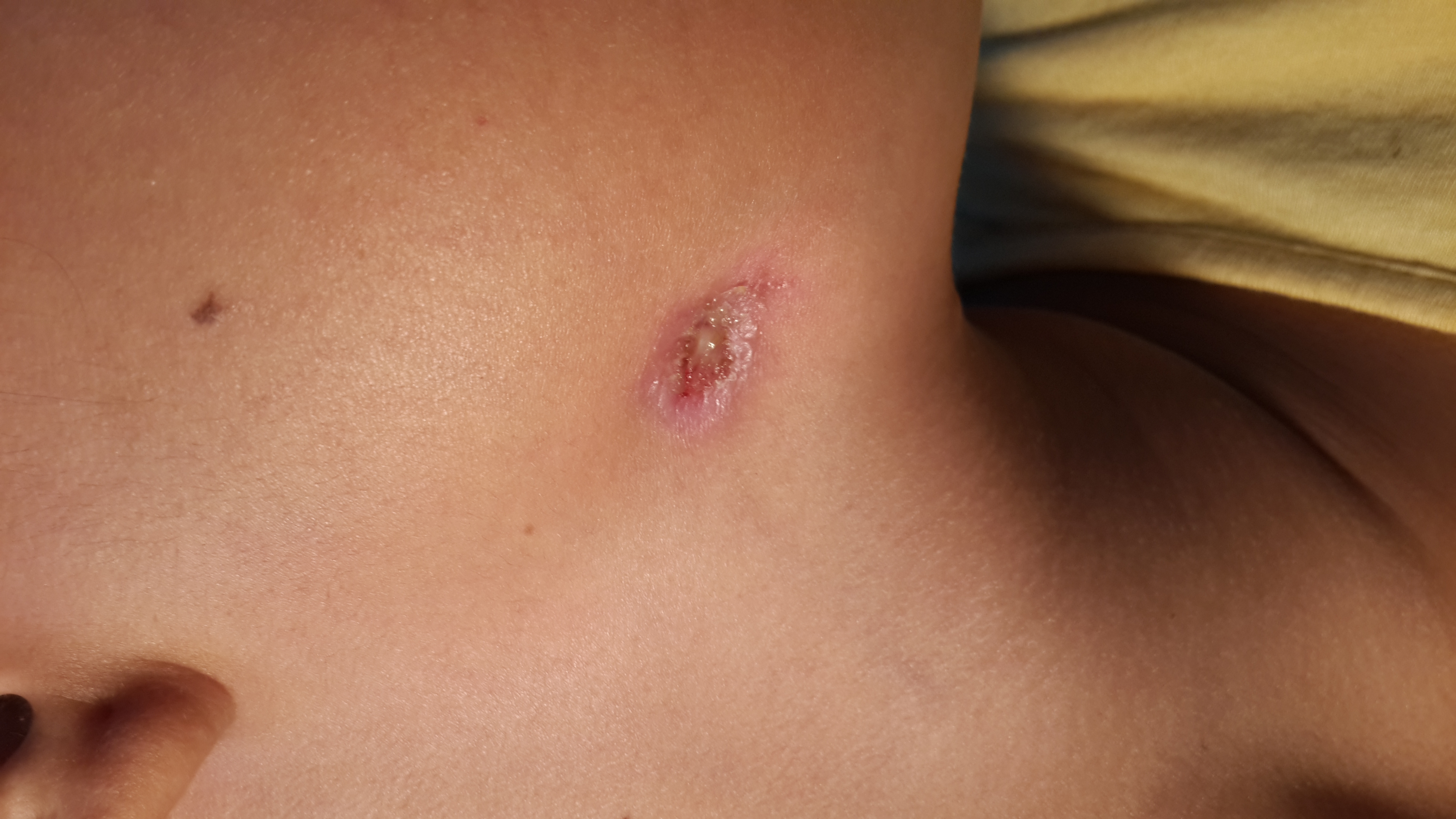 FISTULA CUTANEA PERIODONTOGENICA