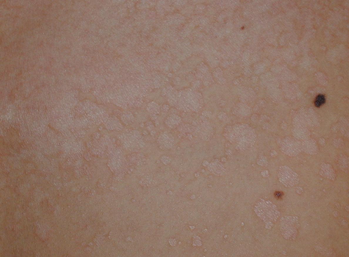 PITIRIASIS VERSICOLOR