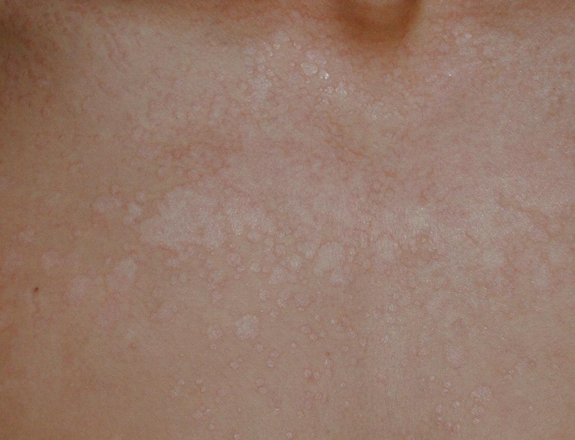 PITIRIASIS VERSICOLOR