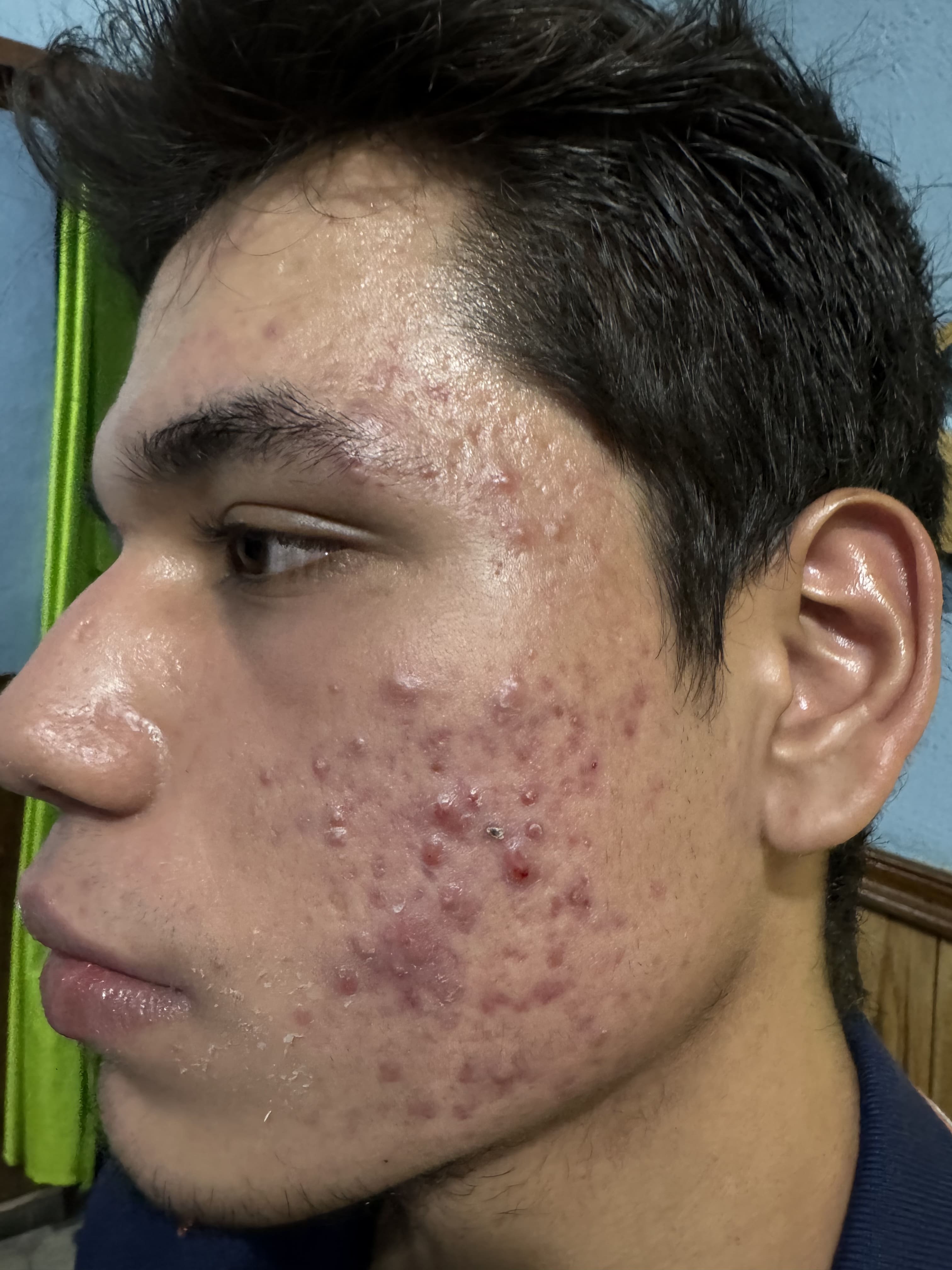 ACNE JUVENIL