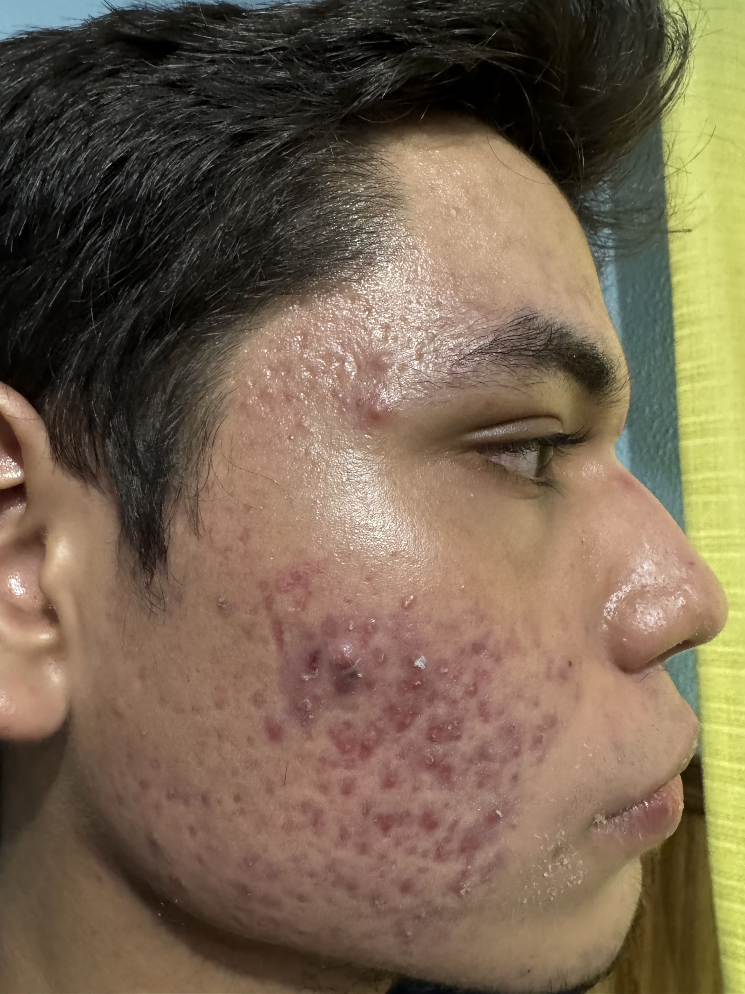ACNE JUVENIL