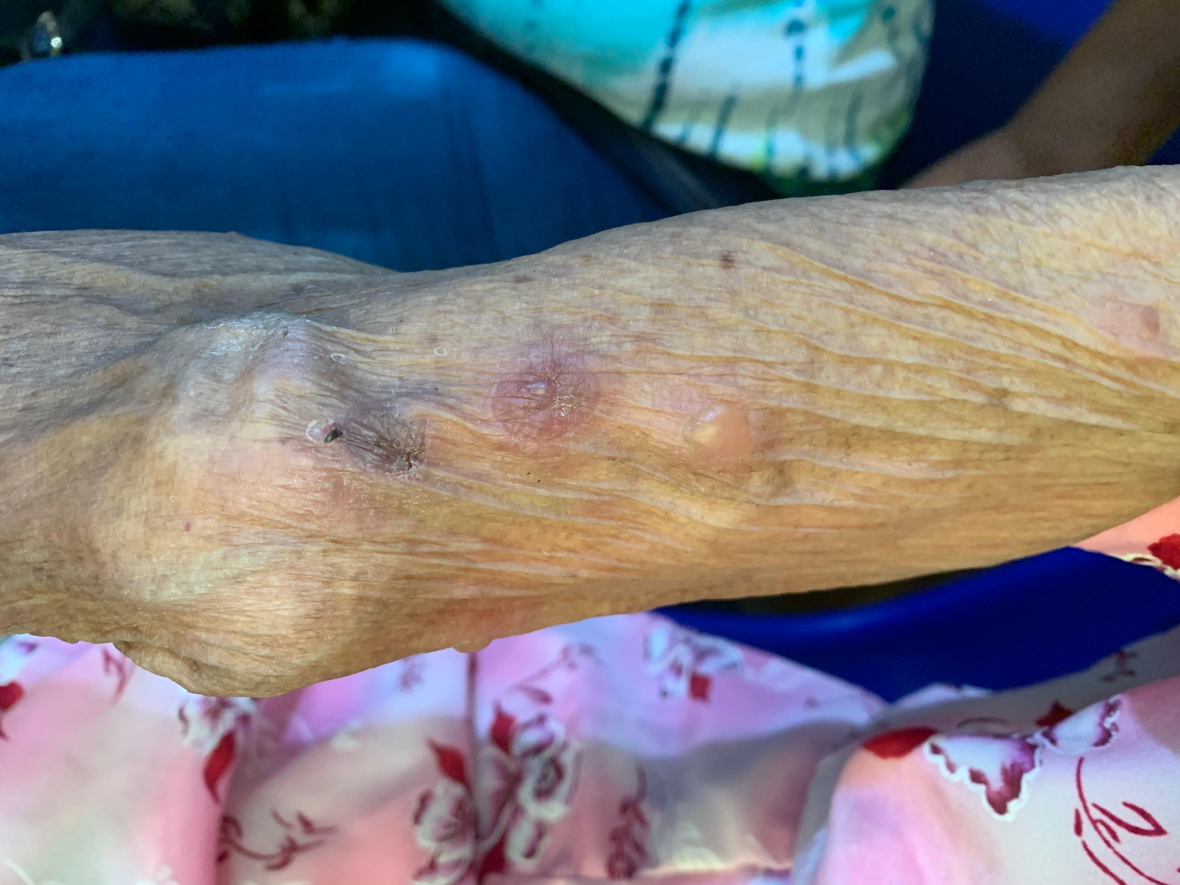 PENFIGOIDE AMPOLLOSO