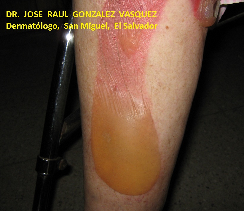 PENFIGOIDE AMPOLLOSO