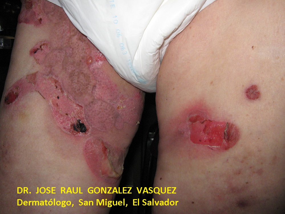 PENFIGOIDE AMPOLLOSO