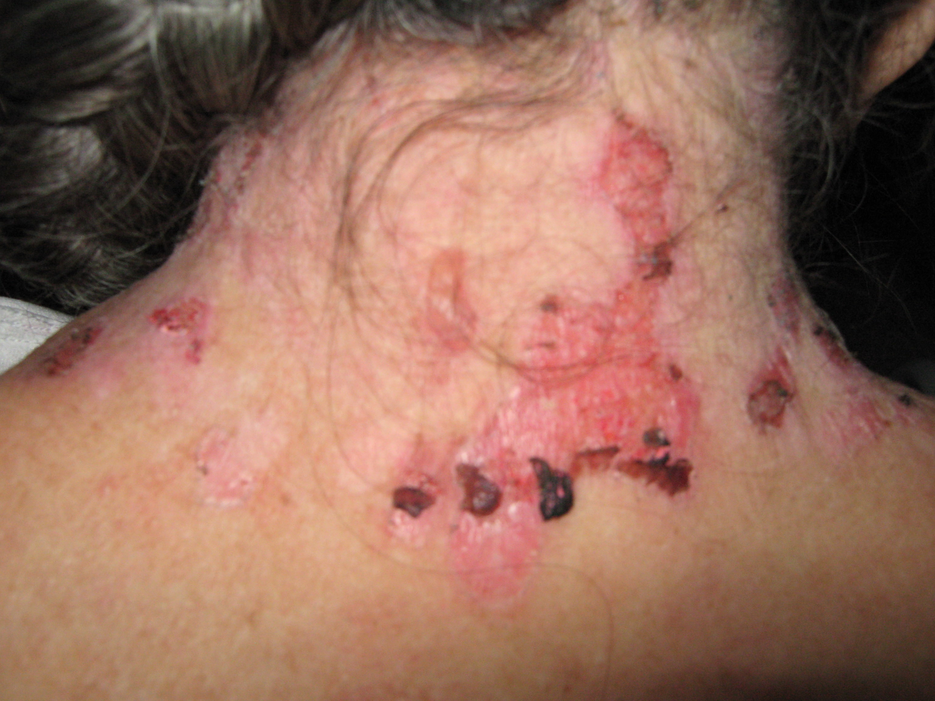 PENFIGOIDE AMPOLLOSO