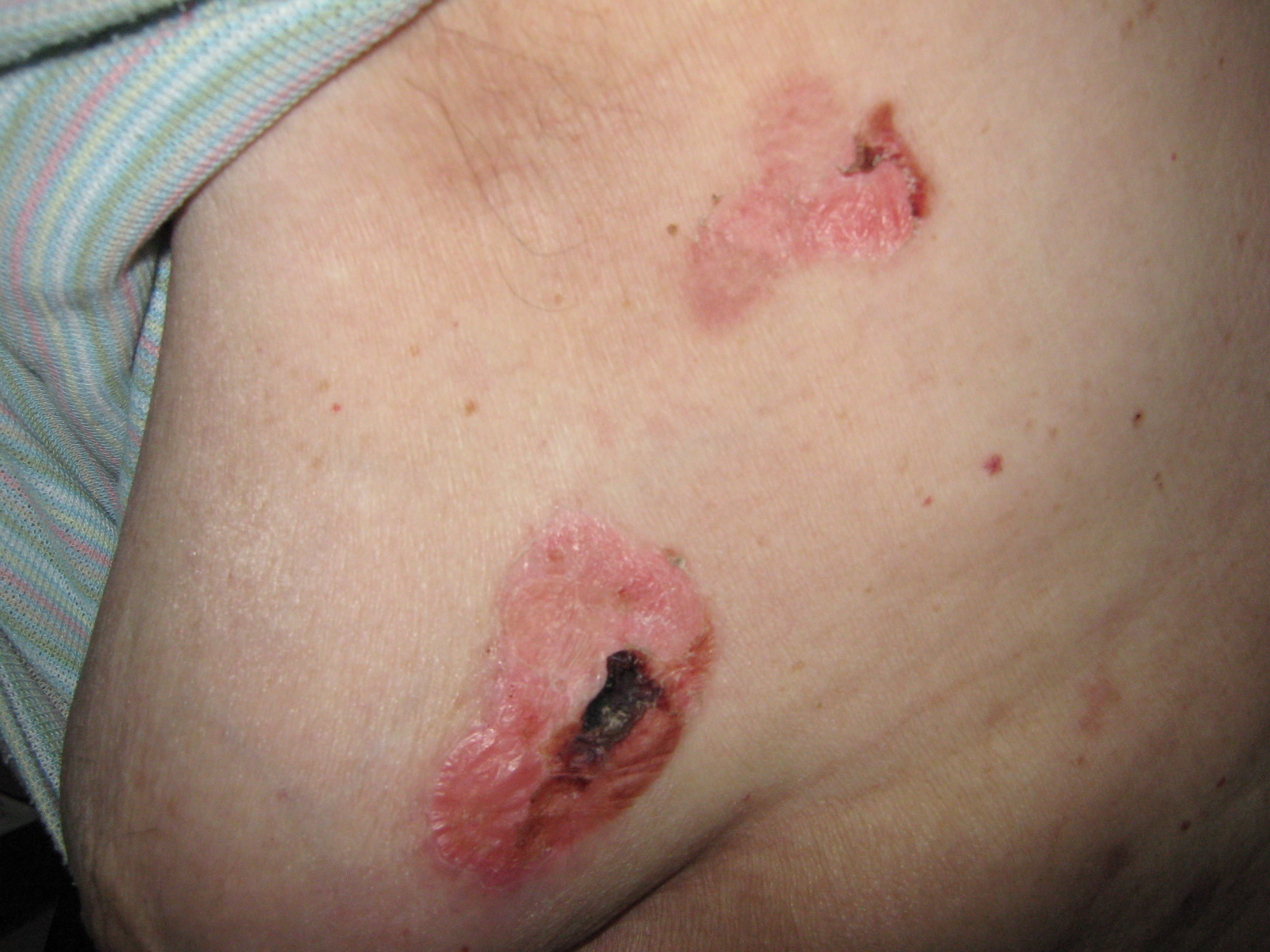 PENFIGOIDE AMPOLLOSO