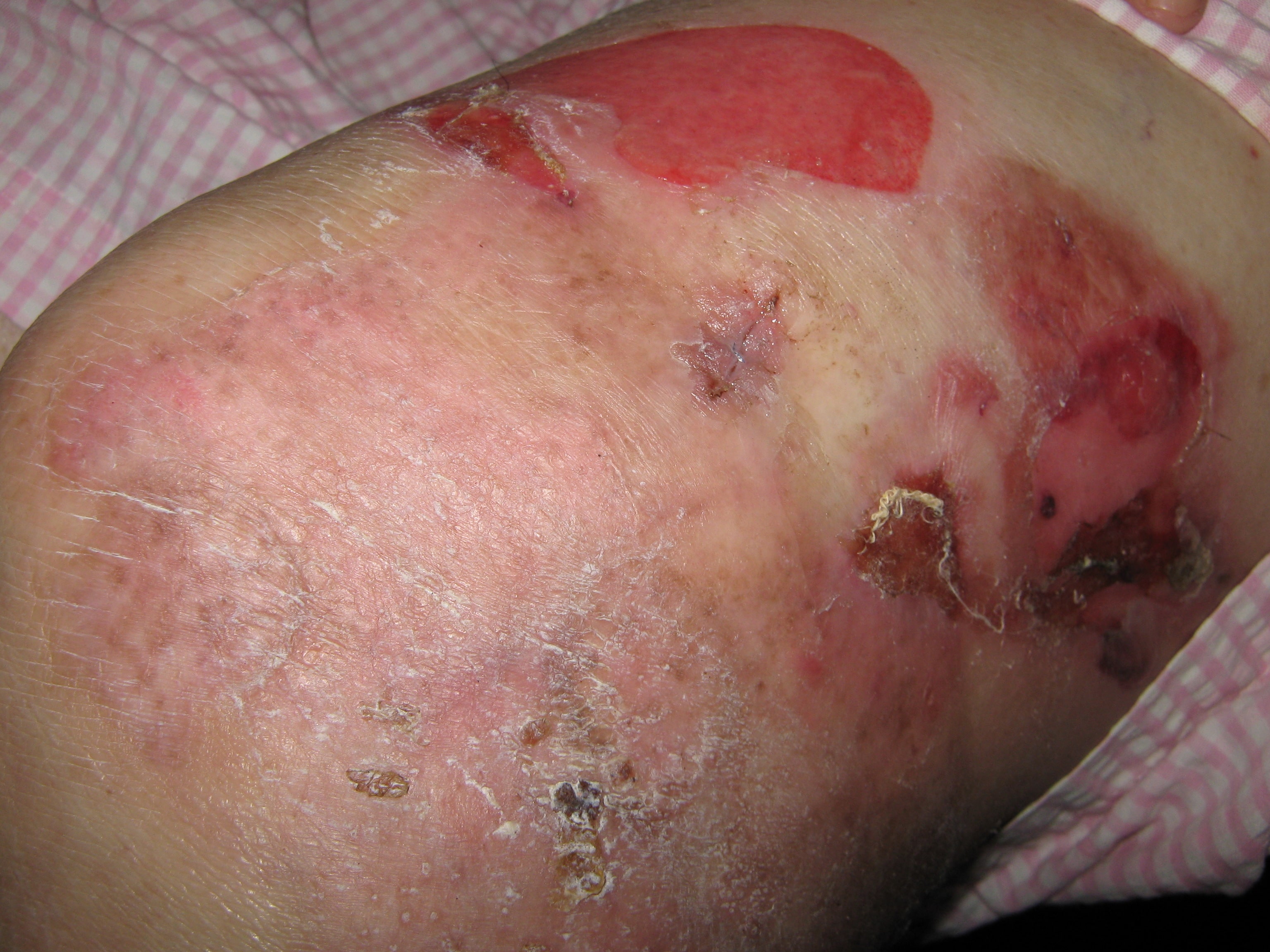 PENFIGOIDE AMPOLLOSO