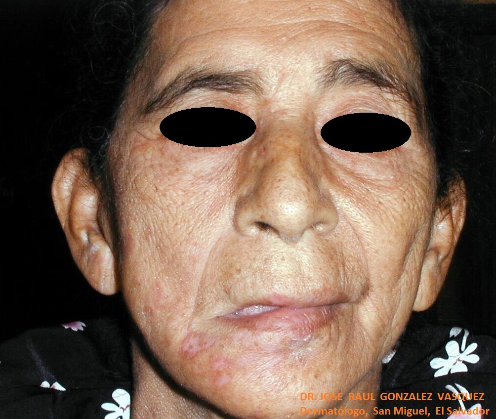 HERPES ZOSTER FACIAL