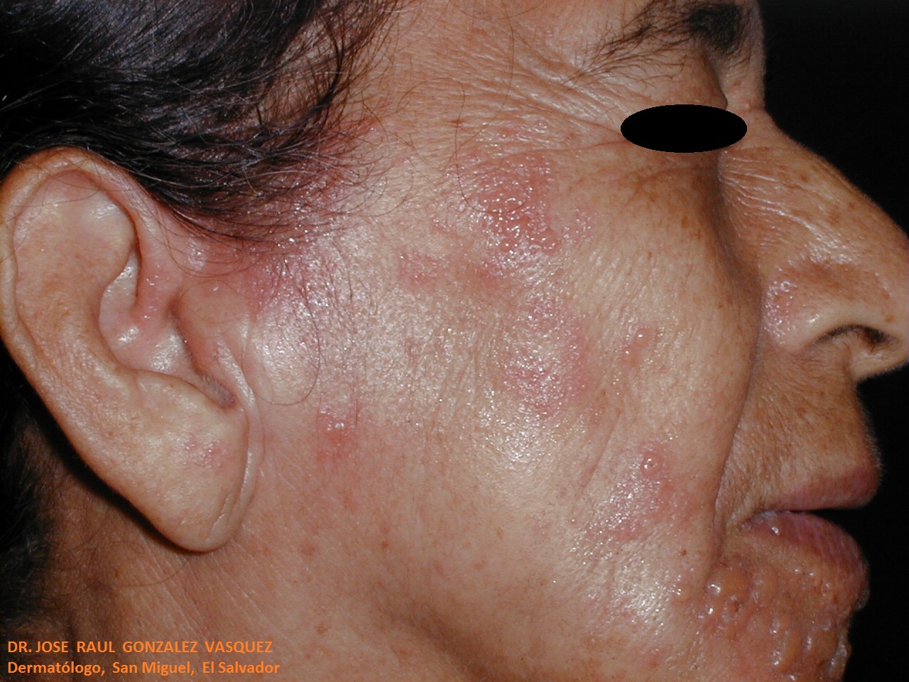 HERPES ZOSTER FACIAL
