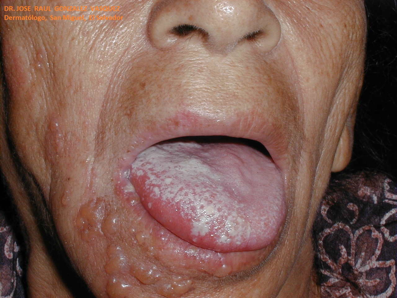 HERPES ZOSTER FACIAL