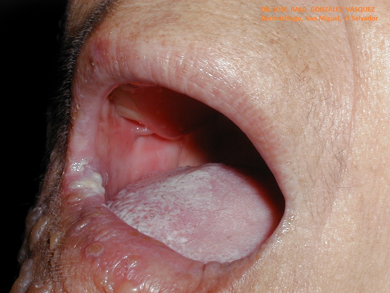 HERPES ZOSTER FACIAL