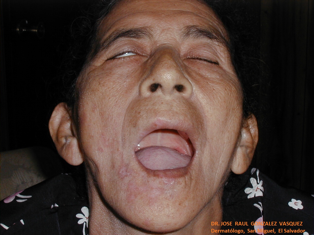HERPES ZOSTER FACIAL