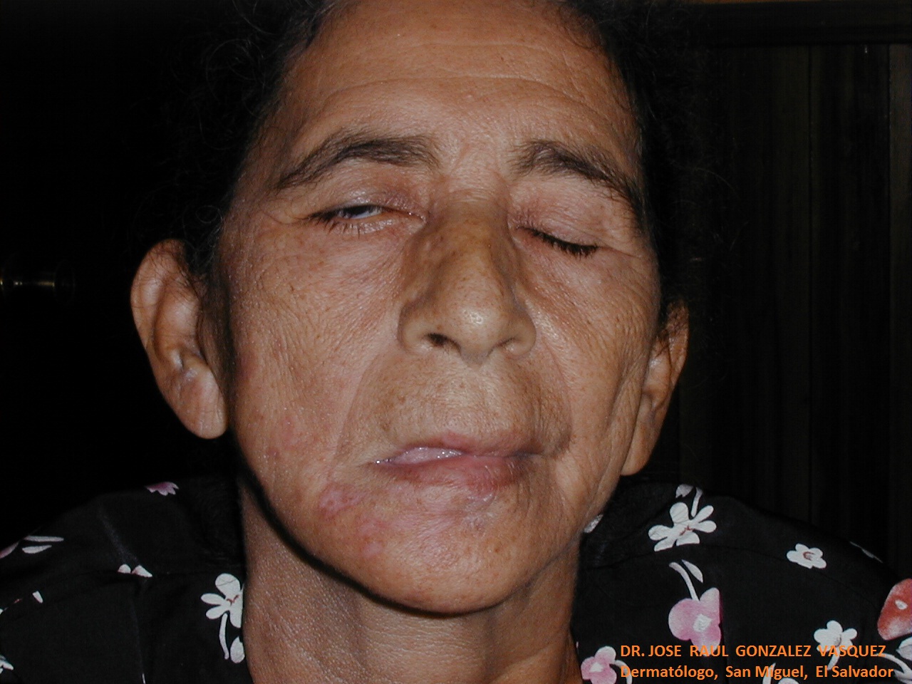 HERPES ZOSTER FACIAL