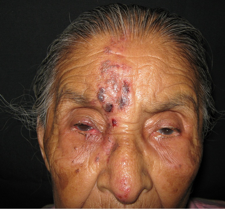 HERPES ZOSTER FACIAL