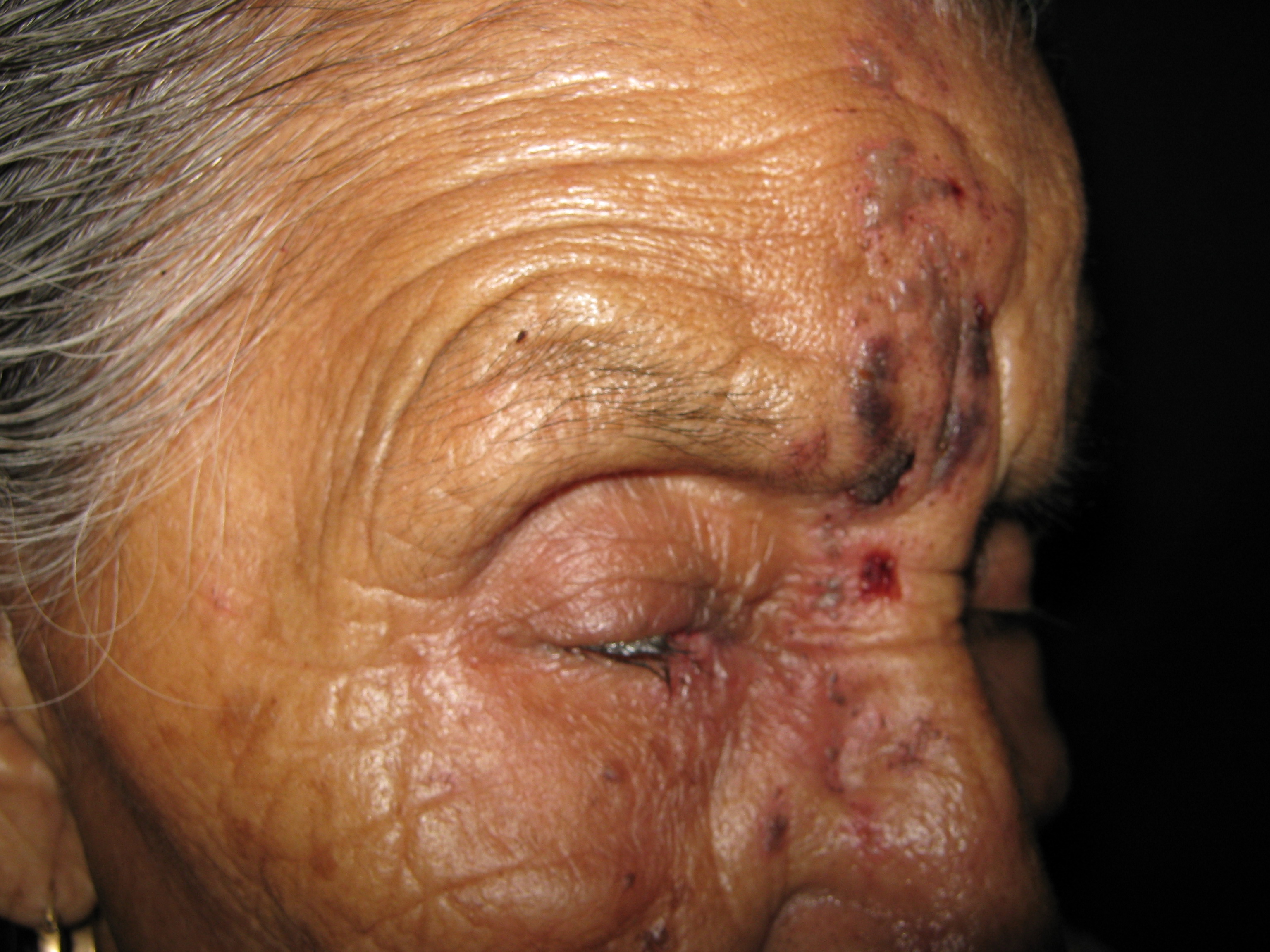 HERPES ZOSTER FACIAL