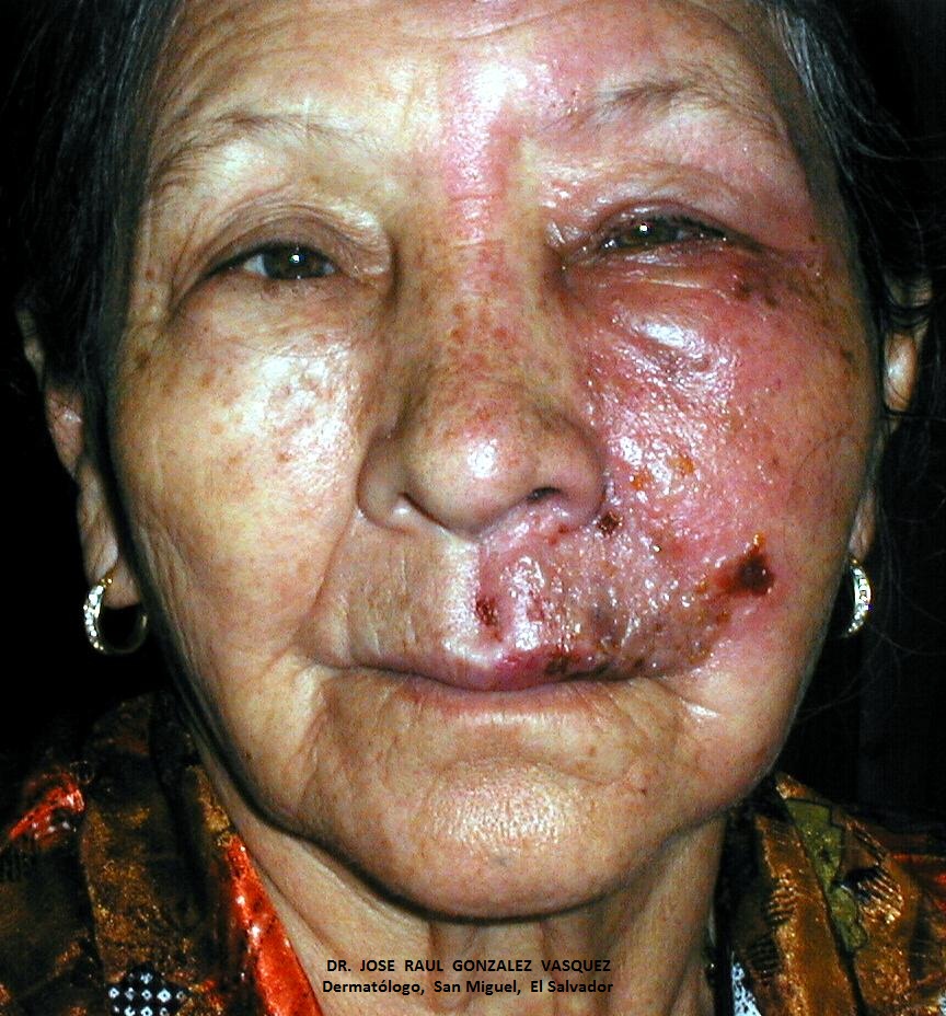 HERPES ZOSTER FACIAL