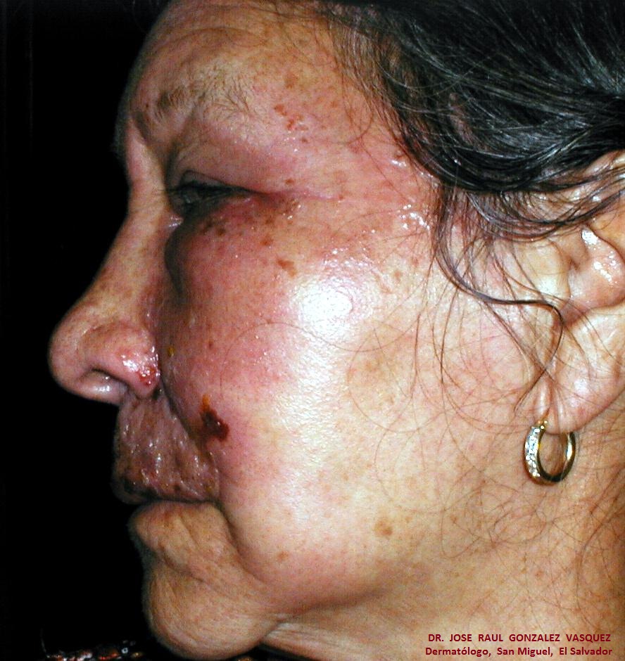 HERPES ZOSTER FACIAL