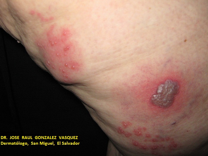 HERPES ZOSTER MIEMBRO INF. IZQUIERDO