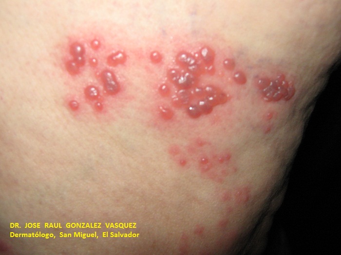HERPES ZOSTER MIEMBRO INF. IZQUIERDO