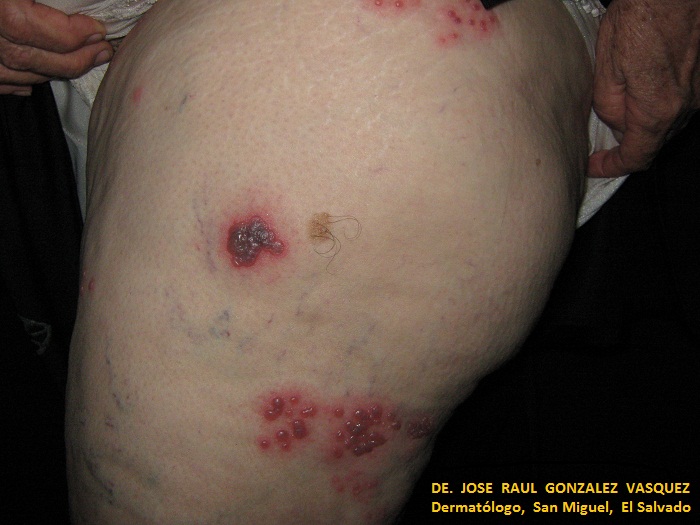 HERPES ZOSTER MIEMBRO INF. IZQUIERDO