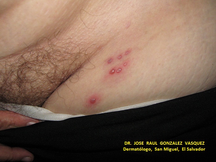 HERPES ZOSTER MIEMBRO INF. IZQUIERDO