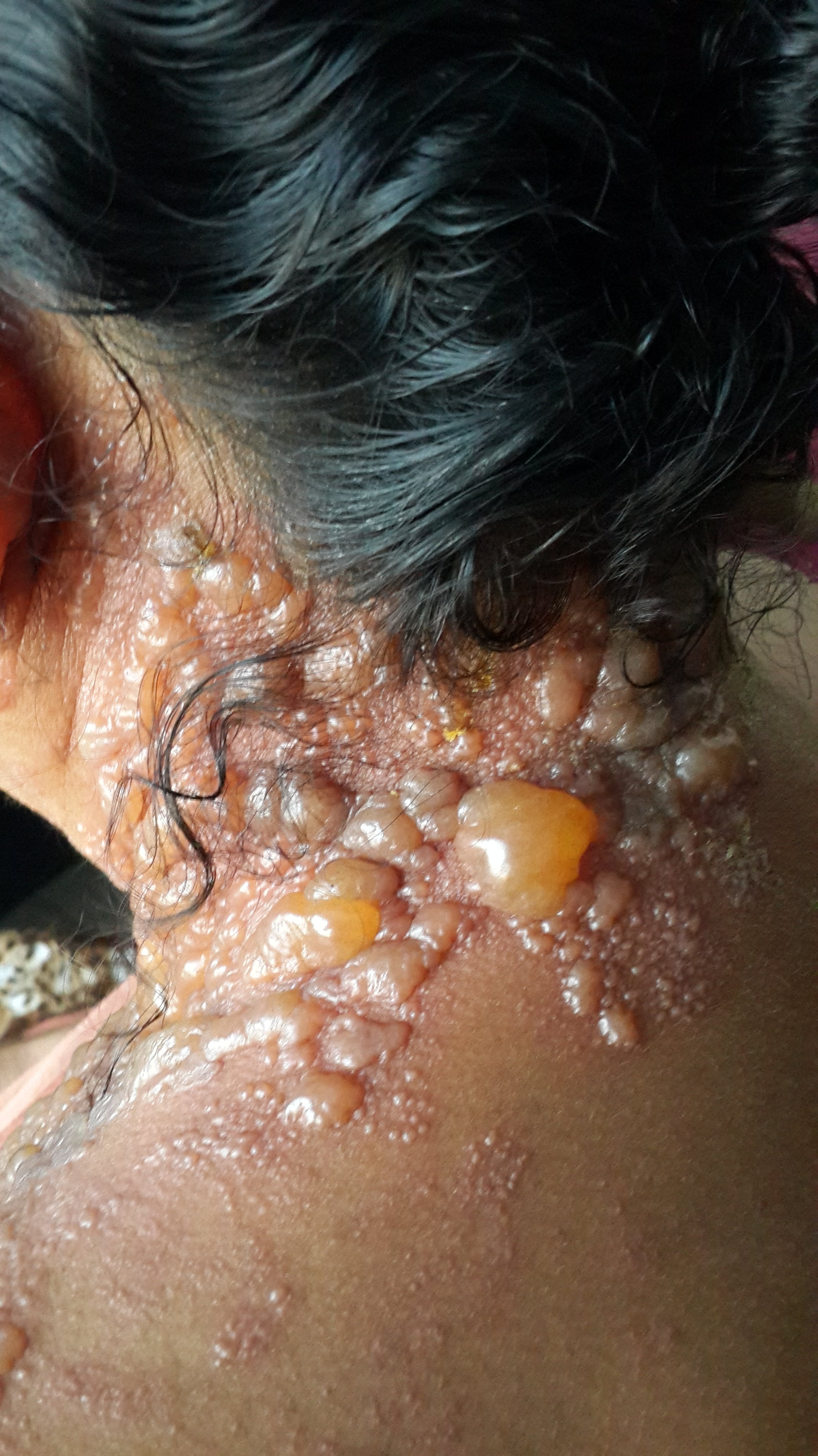 HERPES ZOSTER