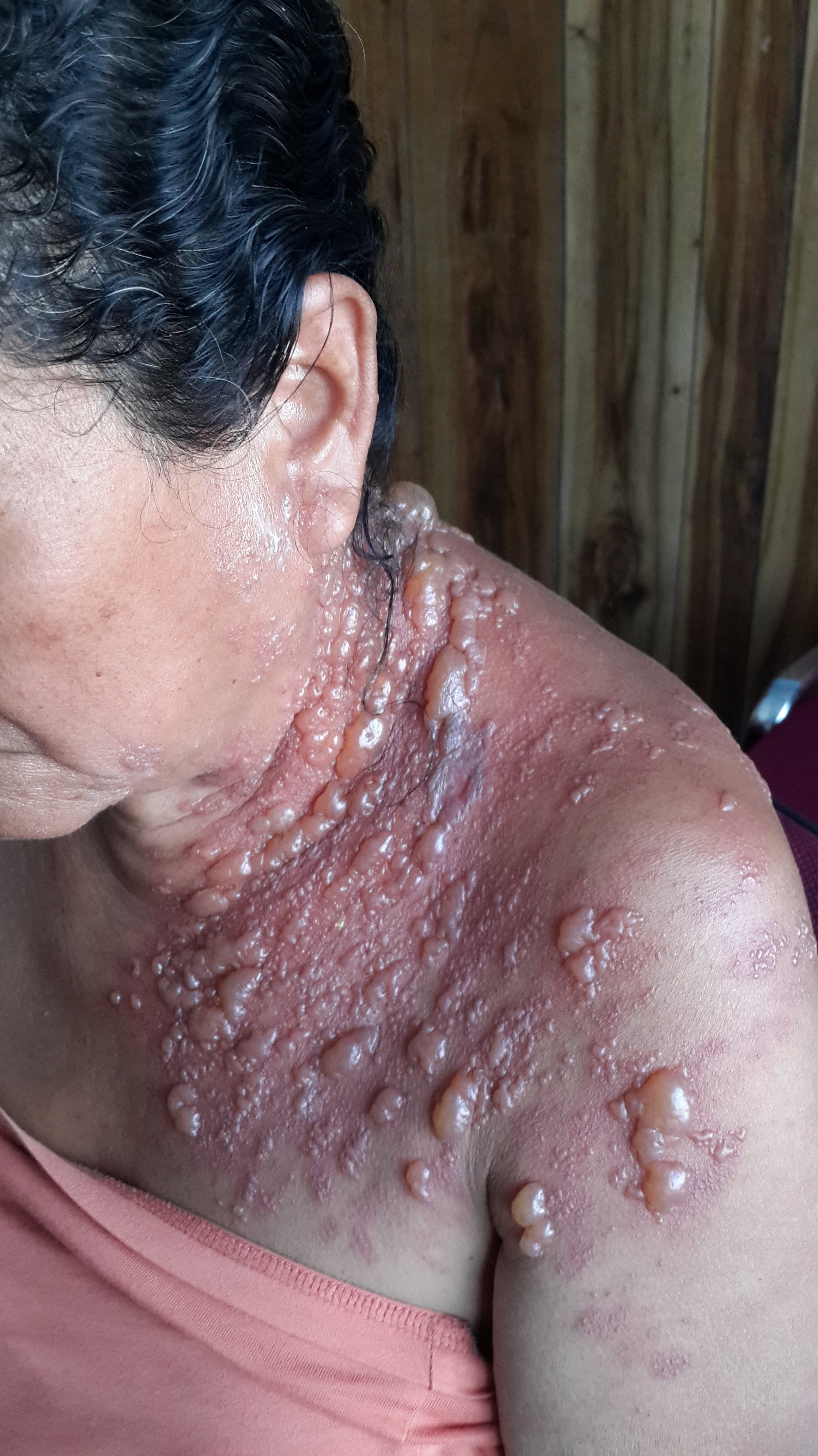 HERPES ZOSTER