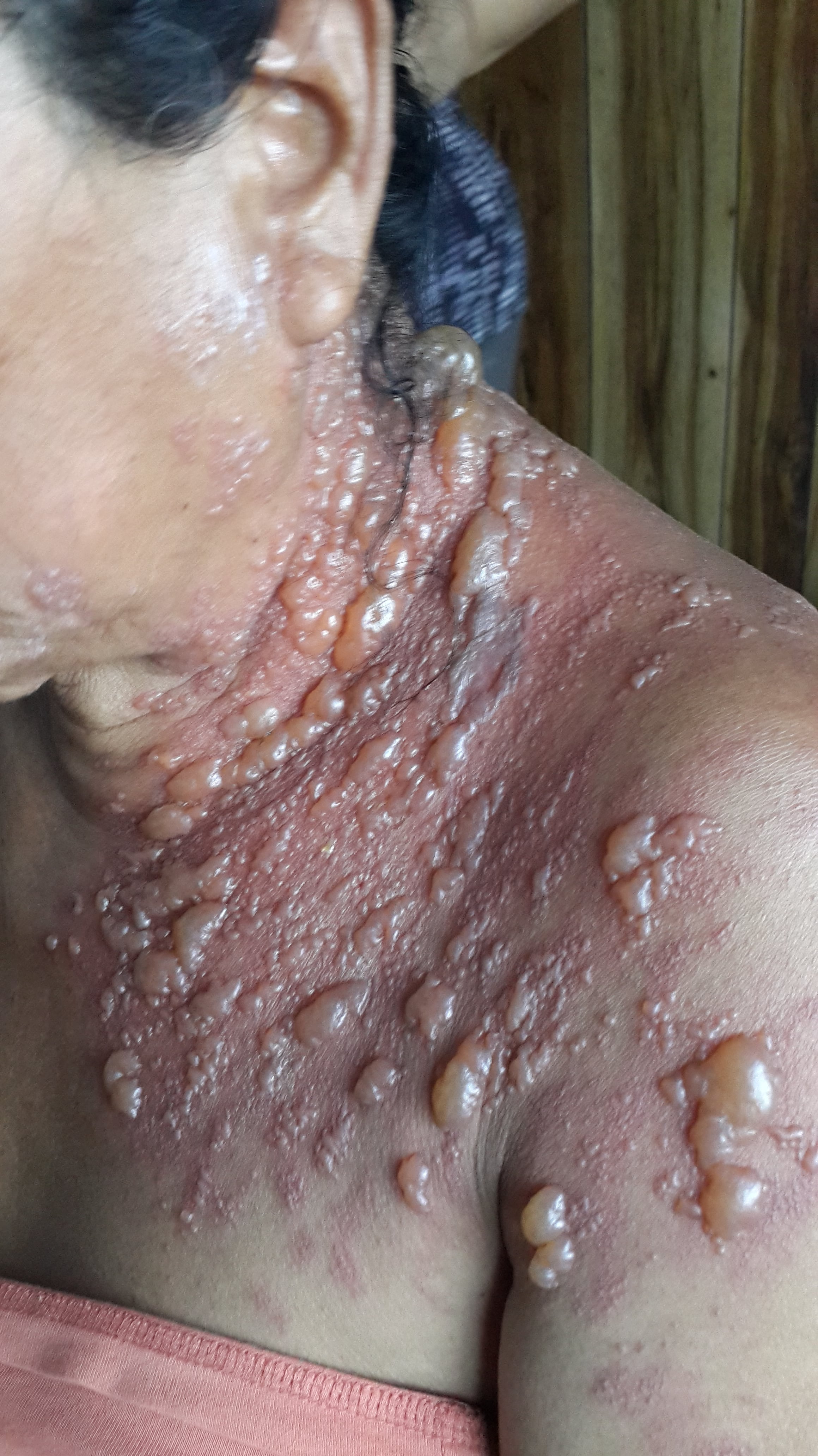 HERPES ZOSTER