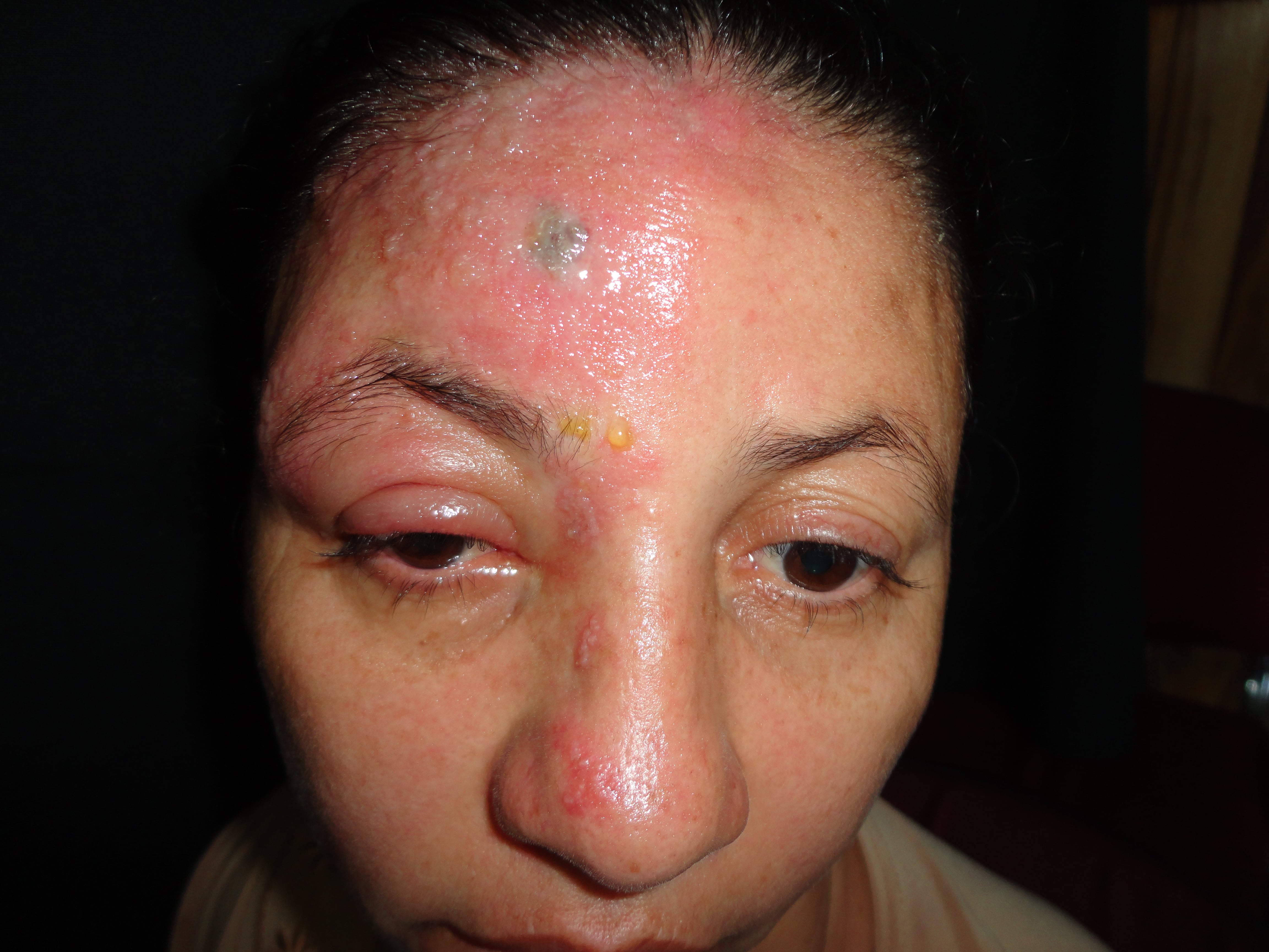 HERPES ZOSTER FACIAL