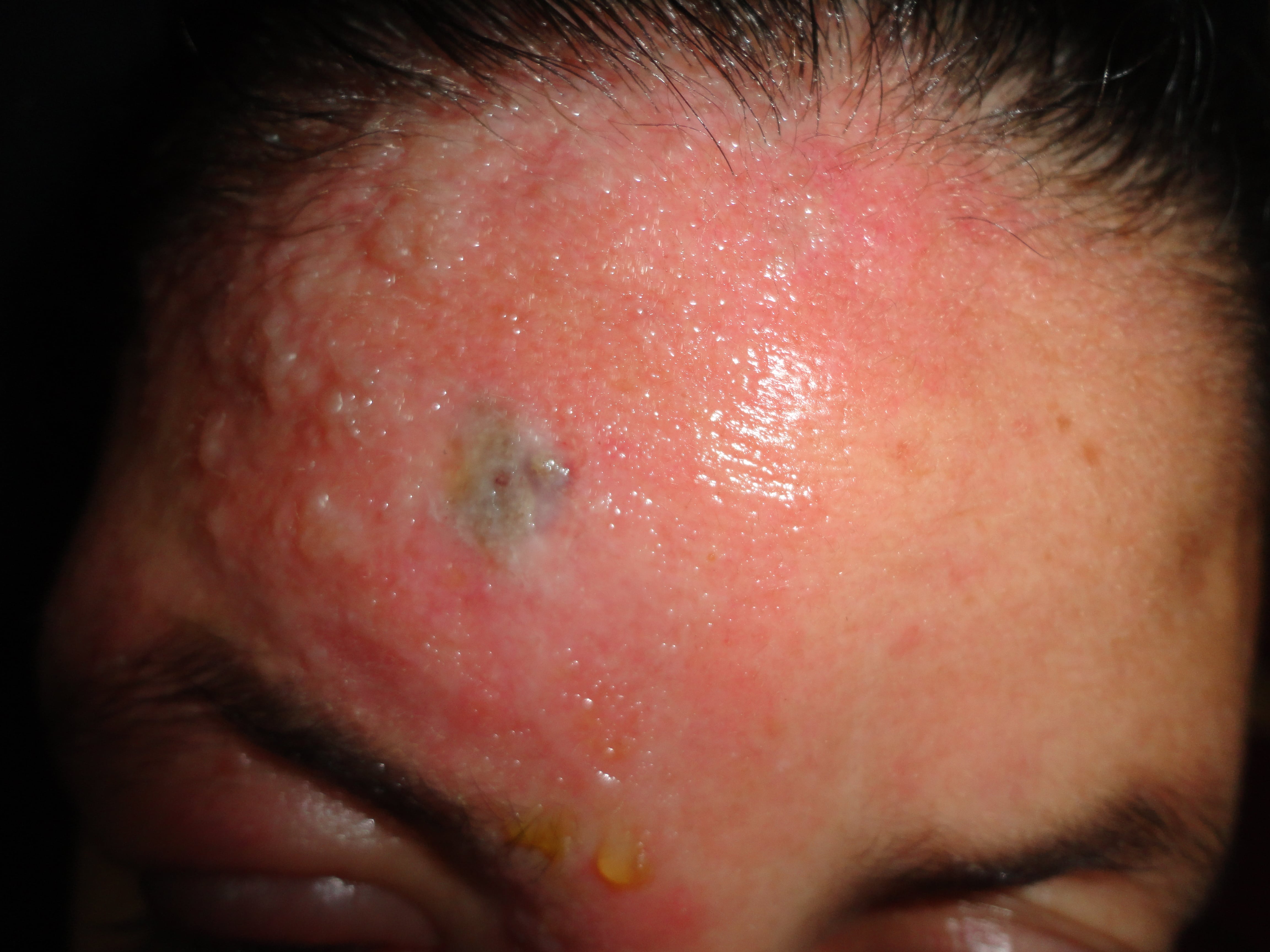 HERPES ZOSTER FACIAL