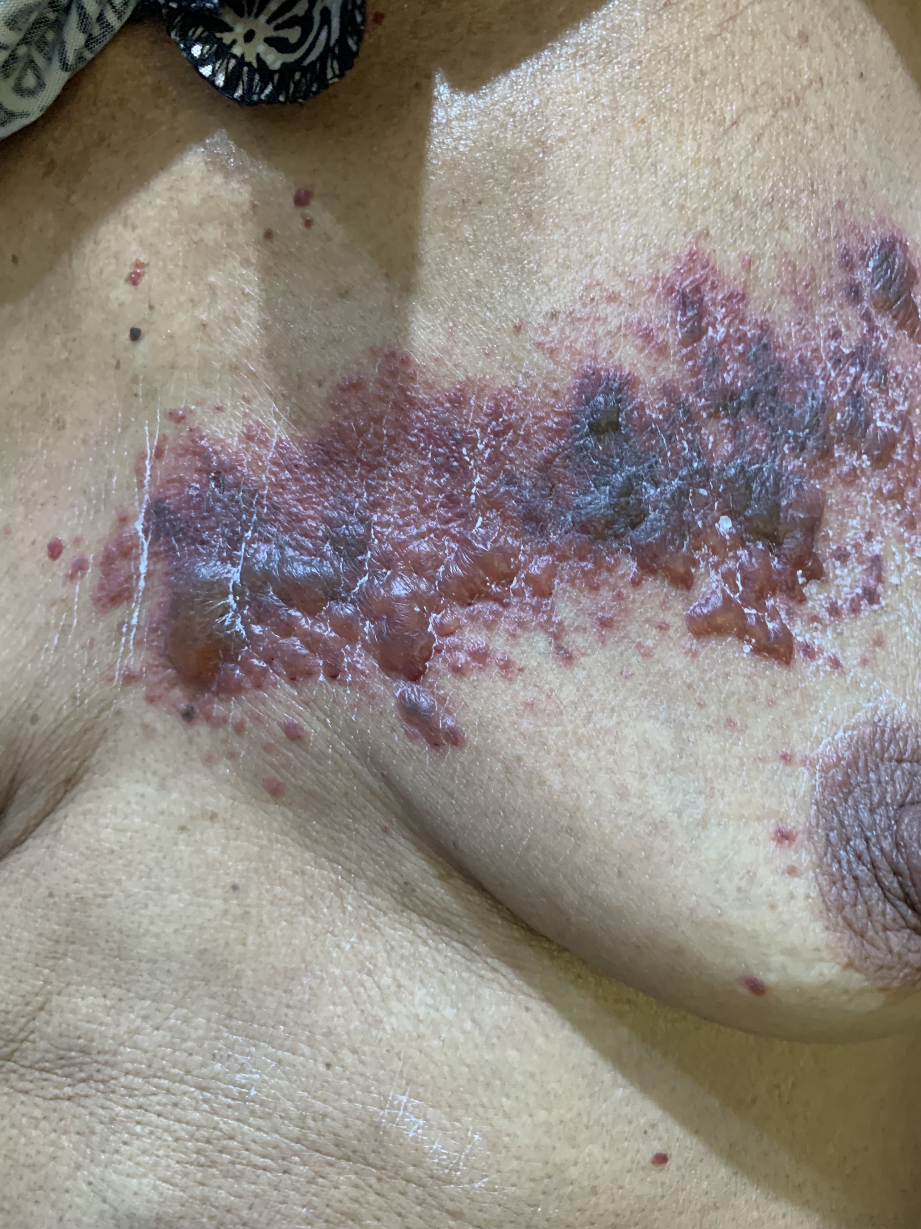 HERPES ZOSTER HEMORRAGICO